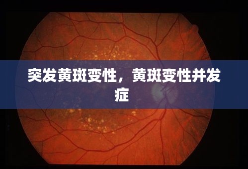 突發(fā)黃斑變性，黃斑變性并發(fā)癥 
