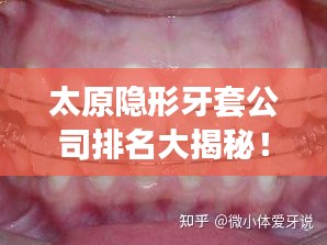太原隱形牙套公司排名大揭秘！專業(yè)矯正牙齒，打造自信笑容！